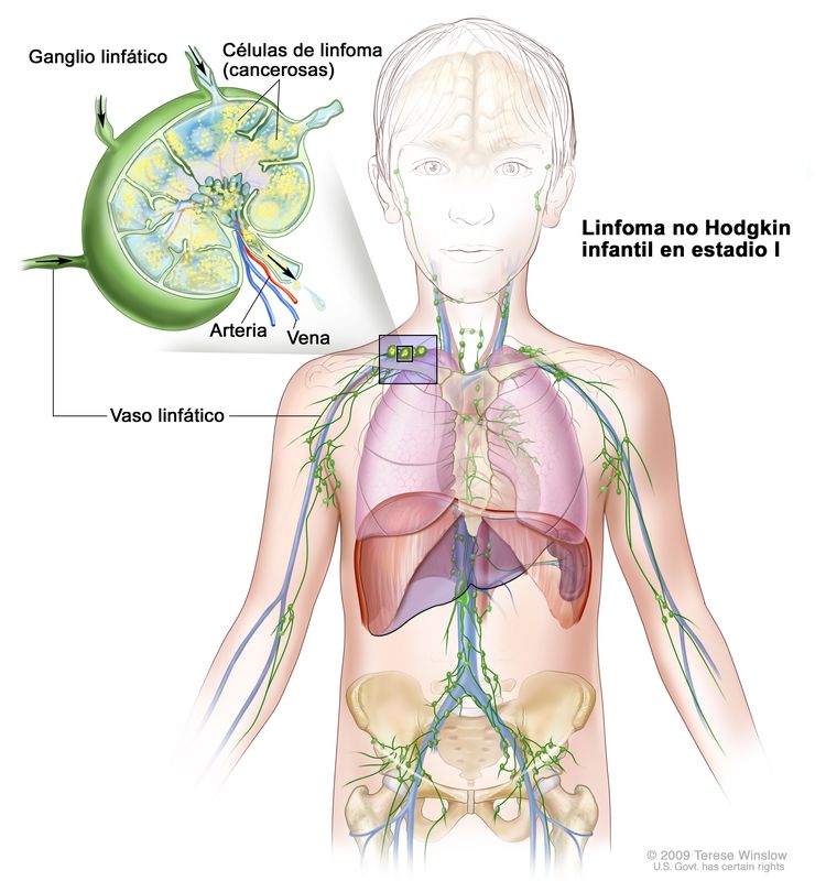 Linfoma no Hodgkin infantil en estadio I; la imagen muestra el cáncer en un grupo de ganglios linfáticos. En el recuadro se observa un ganglio linfático con un vaso linfático, una arteria y una vena. En el ganglio linfático se observan las células de linfoma (cancerosas).