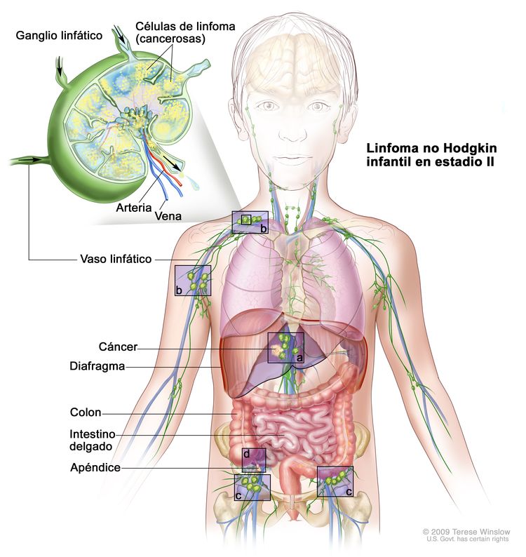Linfoma no Hodgkin infantil en estadio II; la imagen muestra el cáncer en grupos de ganglios linfáticos por encima o debajo del diafragma, en el hígado y en el apéndice. También se observan el intestino delgado y el colon. En el recuadro se observa un ganglio linfático con un vaso linfático, una arteria y una vena. En el ganglio linfático se observan las células de linfoma (cancerosas).