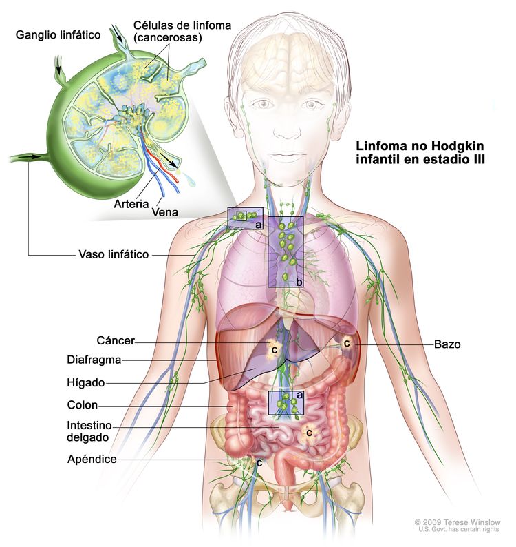 Linfoma no Hodgkin infantil en estadio III; la imagen muestra el cáncer en grupos de ganglios linfáticos por encima y debajo del diafragma, en el pecho y, por todo el abdomen, en el hígado, el bazo, el intestino delgado y el apéndice. También se observa el colon. En el recuadro se observa un ganglio linfático con un vaso linfático, una arteria y una vena. En el ganglio linfático se observan las células de linfoma (cancerosas).