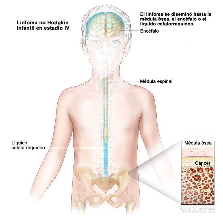 Linfoma no Hodgkin infantil en estadio IV; la imagen muestra el cerebro, la médula espinal y el líquido cefalorraquídeo en el cerebro y la médula espinal y alrededor de estos. En el recuadro se observa el cáncer en la médula ósea.