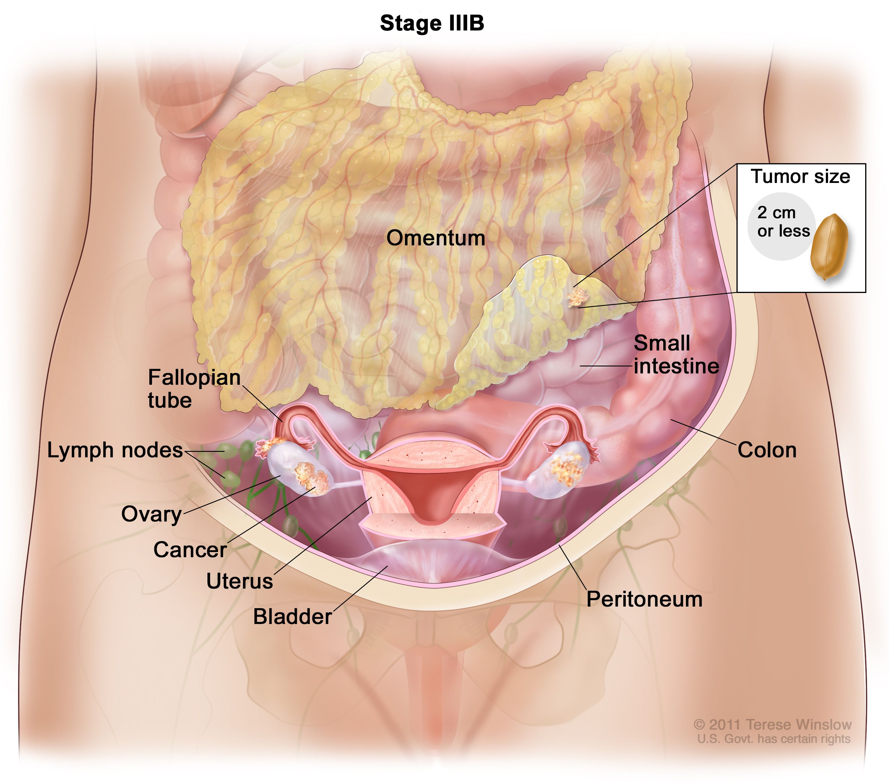 Peritoneal cancer index
