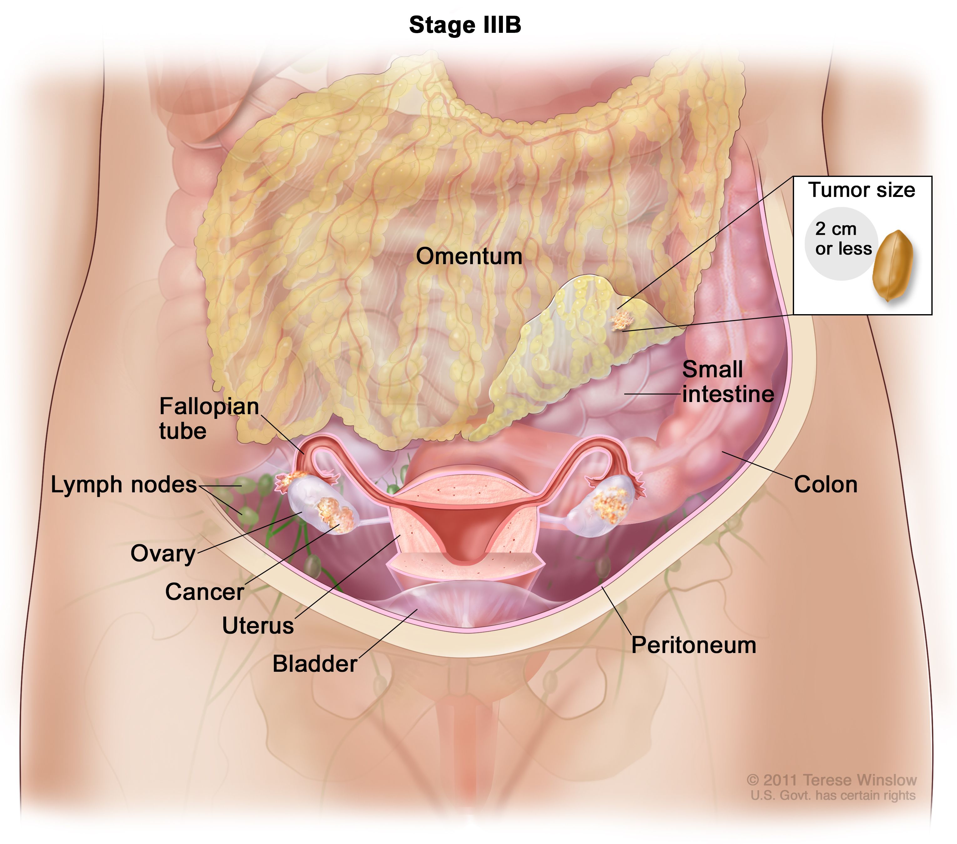 PDF) Predictive value of omental thickness on ultrasonography for diagnosis  of unexplained ascites, an Egyptian centre study