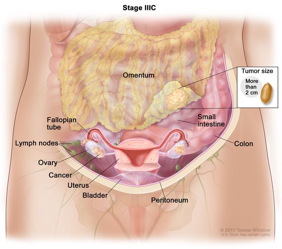 Peritoneal cancer omentum, Helmintii pot parazita
