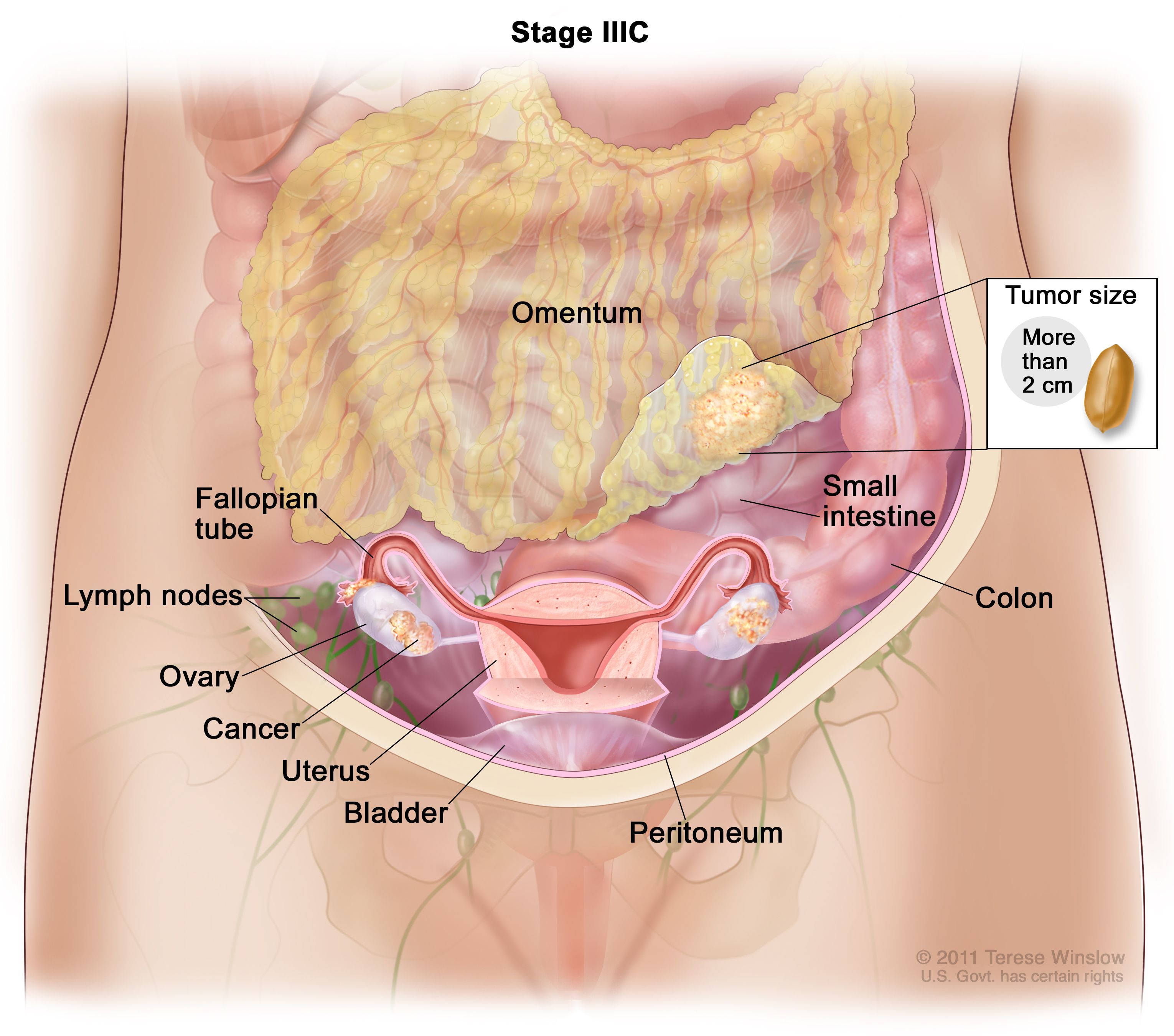 metastatic cancer ovarian)