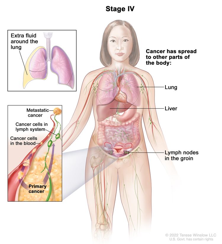Drawing of stage IV shows other parts of the body where ovarian cancer, fallopian tube cancer, and primary peritoneal cancer may spread, including the lung, liver, bone, and lymph nodes in the groin. An inset on the top shows extra fluid around the lung. An inset on the bottom shows cancer cells spreading through the blood and lymph system to another part of the body where metastatic cancer has formed.