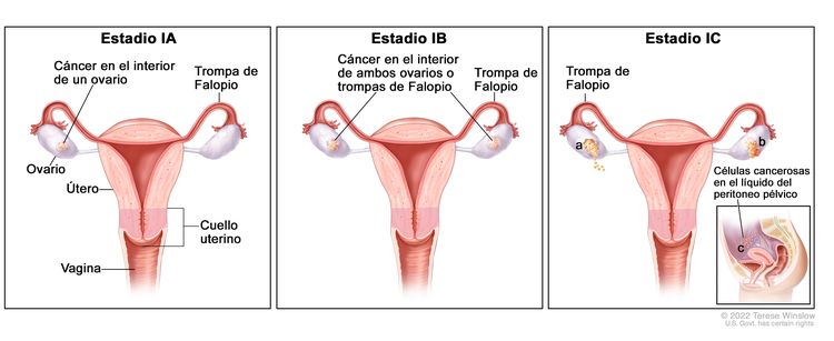Figura de tres paneles de los estadios IA, IB y IC; los paneles muestran los ovarios, las trompas de Falopio, el útero, el cuello uterino y la vagina. El primer panel (estadio IA) muestra cáncer en el interior de un ovario. El segundo panel (estadio IB) muestra cáncer en el interior de ambos ovarios. El tercer panel (estadio IC) muestra cáncer en el interior de ambos ovarios y a) el tumor en el ovario de la izquierda se rompió (se abrió), b) el ovario de la derecha tiene cáncer en la superficie y c) el líquido del peritoneo pélvico tiene células cancerosas (recuadro).