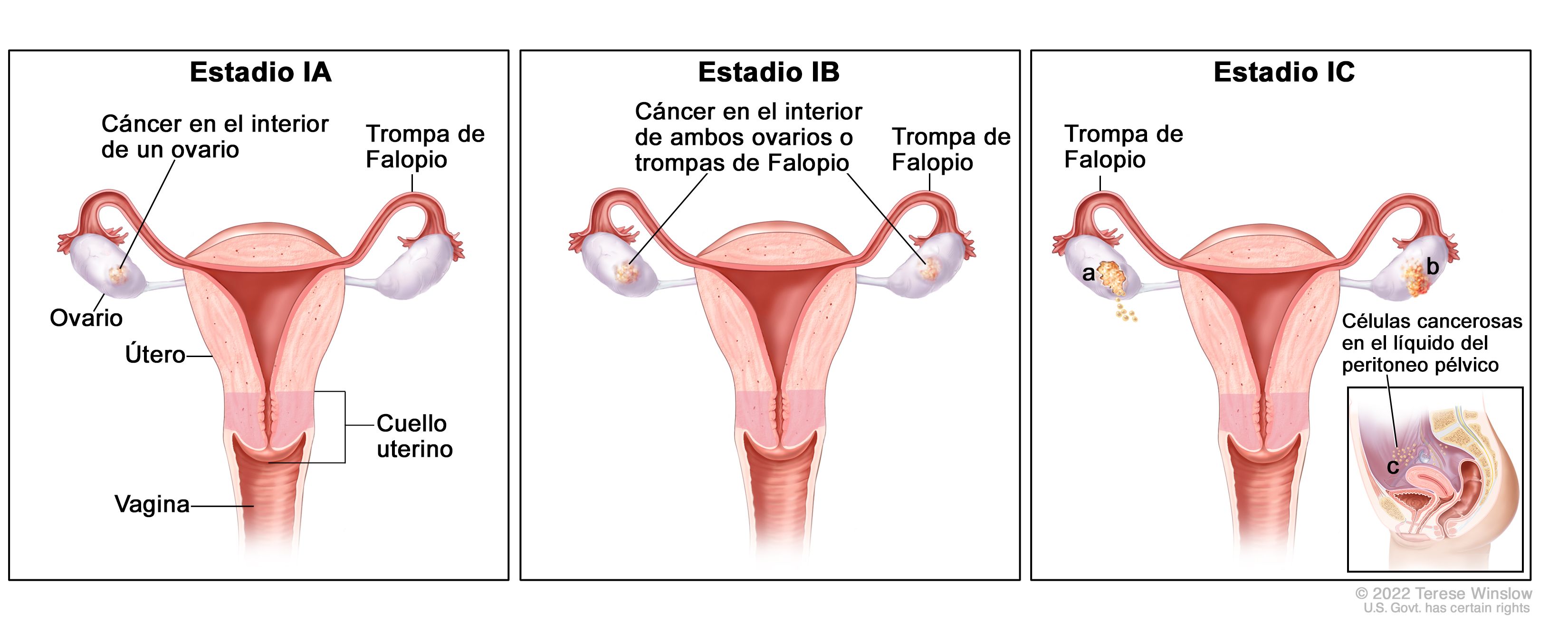 Cancer epitelial ovarico