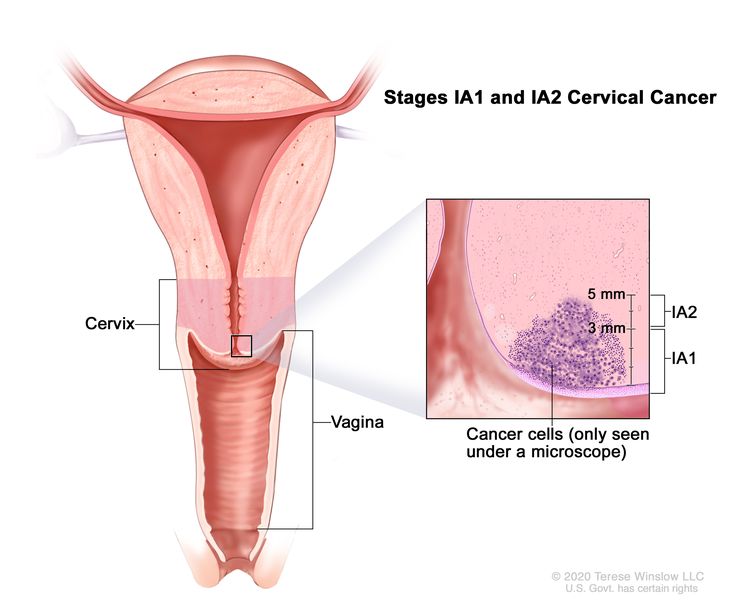 Stage IA1 and IA2 cervical cancer; drawing shows a cross-section of the cervix and vagina. An inset shows cancer cells in the cervix that can only be seen under a microscope. The cancer in stage IA1 is not more than 3 mm deep. The cancer in stage IA2 is more than 3 but not more than 5 mm deep.