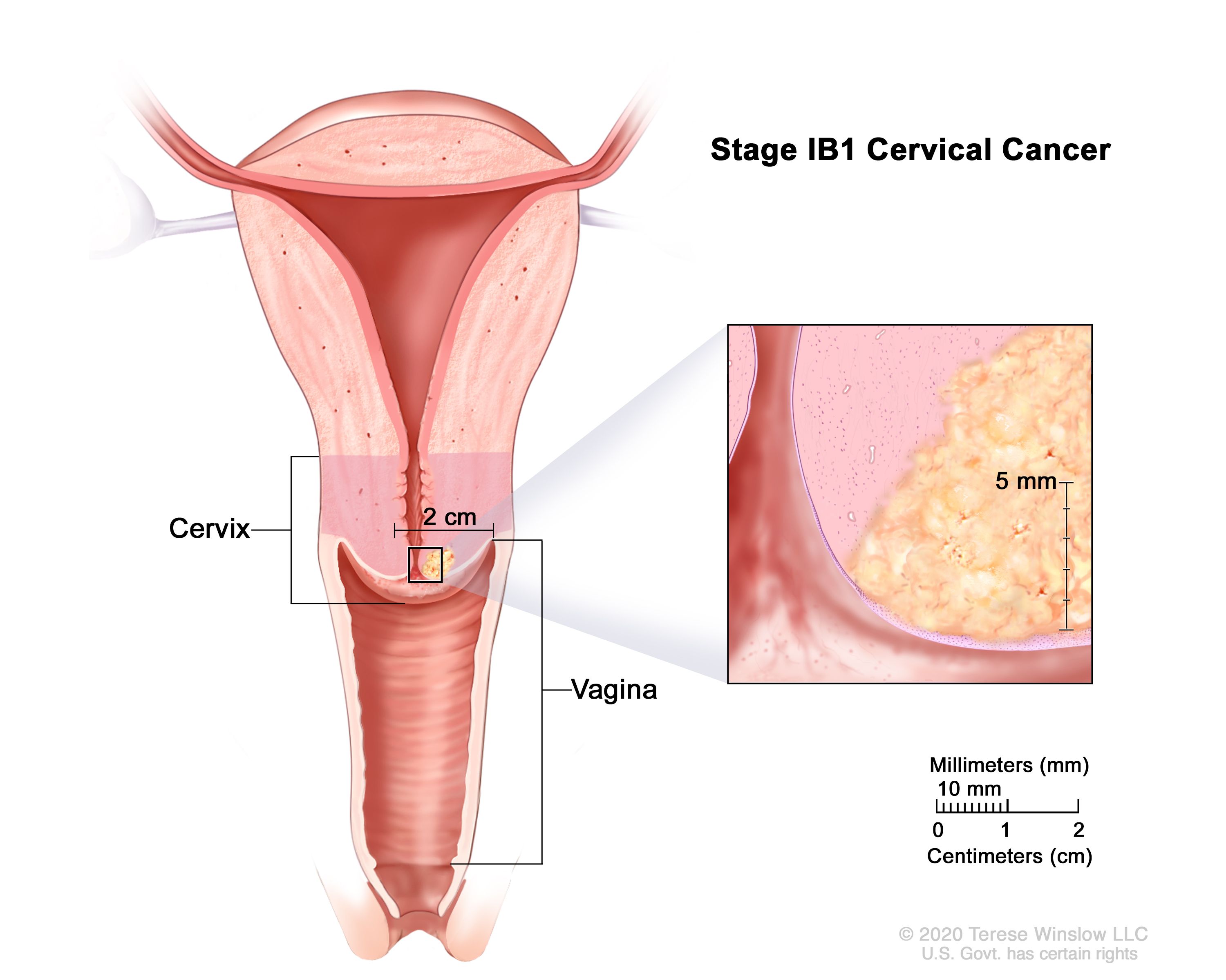 Signs of cancer 10 cervical 10 Warning