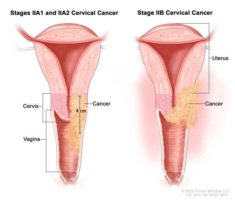 Stage II cervical cancer; drawing shows two cross-sections of the uterus, cervix, and vagina. The drawing on the left shows stages IIA1 and IIA2 cancer in the cervix that is 4 cm and has spread to the upper two-thirds of the vagina. The drawing on the right shows stage IIB cancer that has spread from the cervix to the tissue around the uterus.