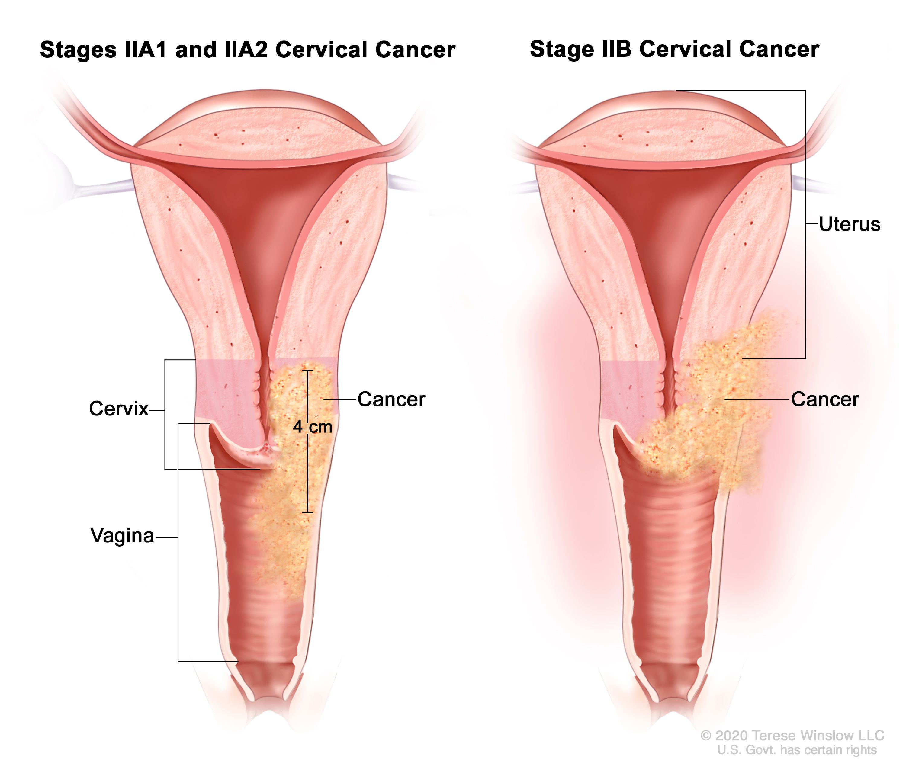 Definition of cervix - NCI Dictionary of Cancer Terms - NCI