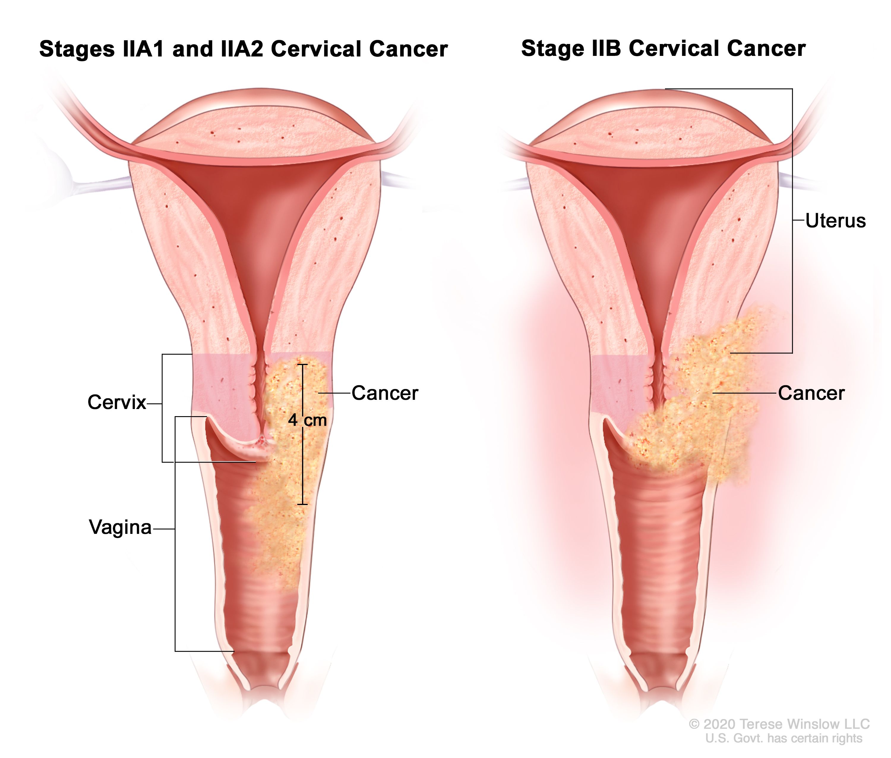 Cervical Cancer Treatment Pdq® Nci 7903