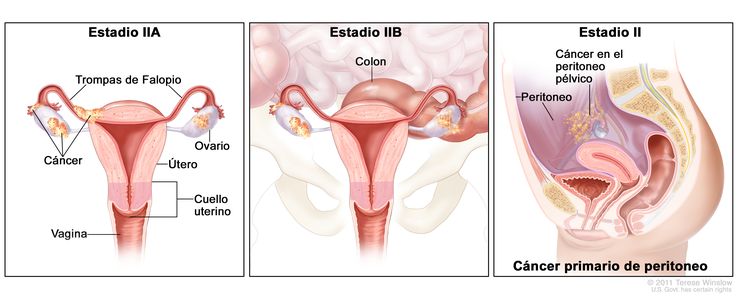 Figura de tres paneles para el cáncer primario de peritoneo en estadios IIA, IIB y II; el primer panel (estadio IIA) muestra cáncer en el interior de ambos ovarios que se diseminó hasta el útero y las trompas de Falopio. El segundo panel (estadio IIB) muestra cáncer en el interior de ambos ovarios que se diseminó hasta el colon. El tercer panel (cáncer primario de peritoneo en estadio II) muestra cáncer en el peritoneo pélvico. También se muestran el cuello uterino y la vagina.
