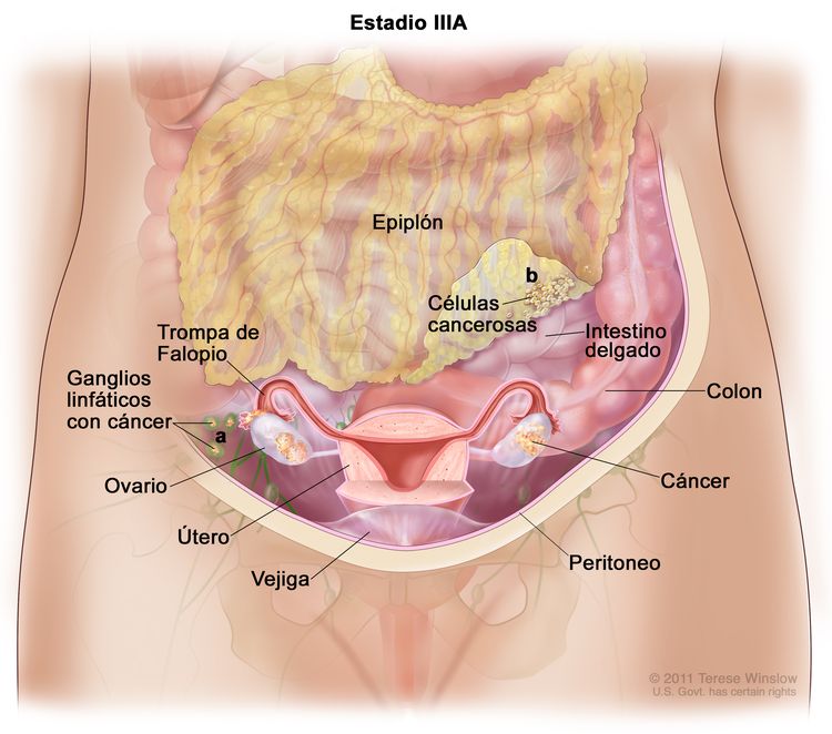 La figura del estadio IIIA muestra cáncer en el interior de ambos ovarios, que se diseminó hacia: a) ganglios linfáticos detrás del peritoneo y b) el epiplón. También se muestran el intestino delgado, el colon, las trompas de Falopio, el útero y la vejiga.