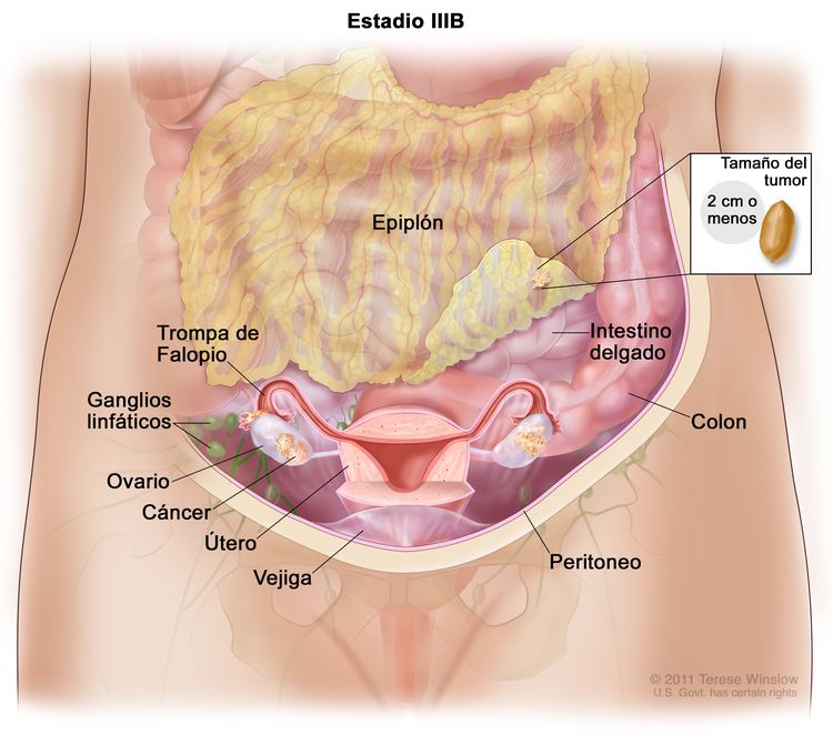 La figura del estadio IIIB muestra cáncer en el interior de ambos ovarios que se diseminó al epiplón. El cáncer en el epiplón mide 2 cm o menos. En un recuadro, se muestra que 2 cm es aproximadamente el tamaño de un maní. También se muestran el intestino delgado, el colon, las trompas de Falopio, el útero, la vejiga y los ganglios linfáticos detrás del peritoneo.