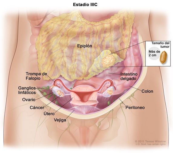 Dibujo del cáncer de ovario en estadio IIIC. Se observa el abdomen de una persona y en su interior se muestran ambos ovarios con cáncer. El cáncer se diseminó al epiplón donde el tumor mide más de 2 cm; en un recuadro pequeño se compara el tamaño del tumor con el de un maní (cacahuete). También se señalan el epiplón, el intestino delgado, el colon, una trompa de Falopio, el peritoneo, un ovario, el útero y la vejiga.