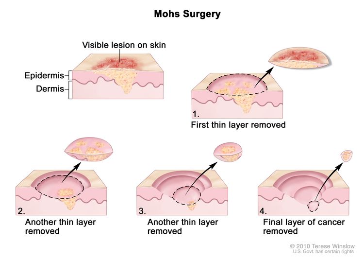 Mohs surgery; drawing shows a visible lesion on the skin. The pullout shows a block of skin with cancer in the epidermis (outer layer of the skin) and the dermis (inner layer of the skin). A visible lesion is shown on the skin’s surface. Four numbered blocks show the removal of thin layers of the skin one at a time until all the cancer is removed.