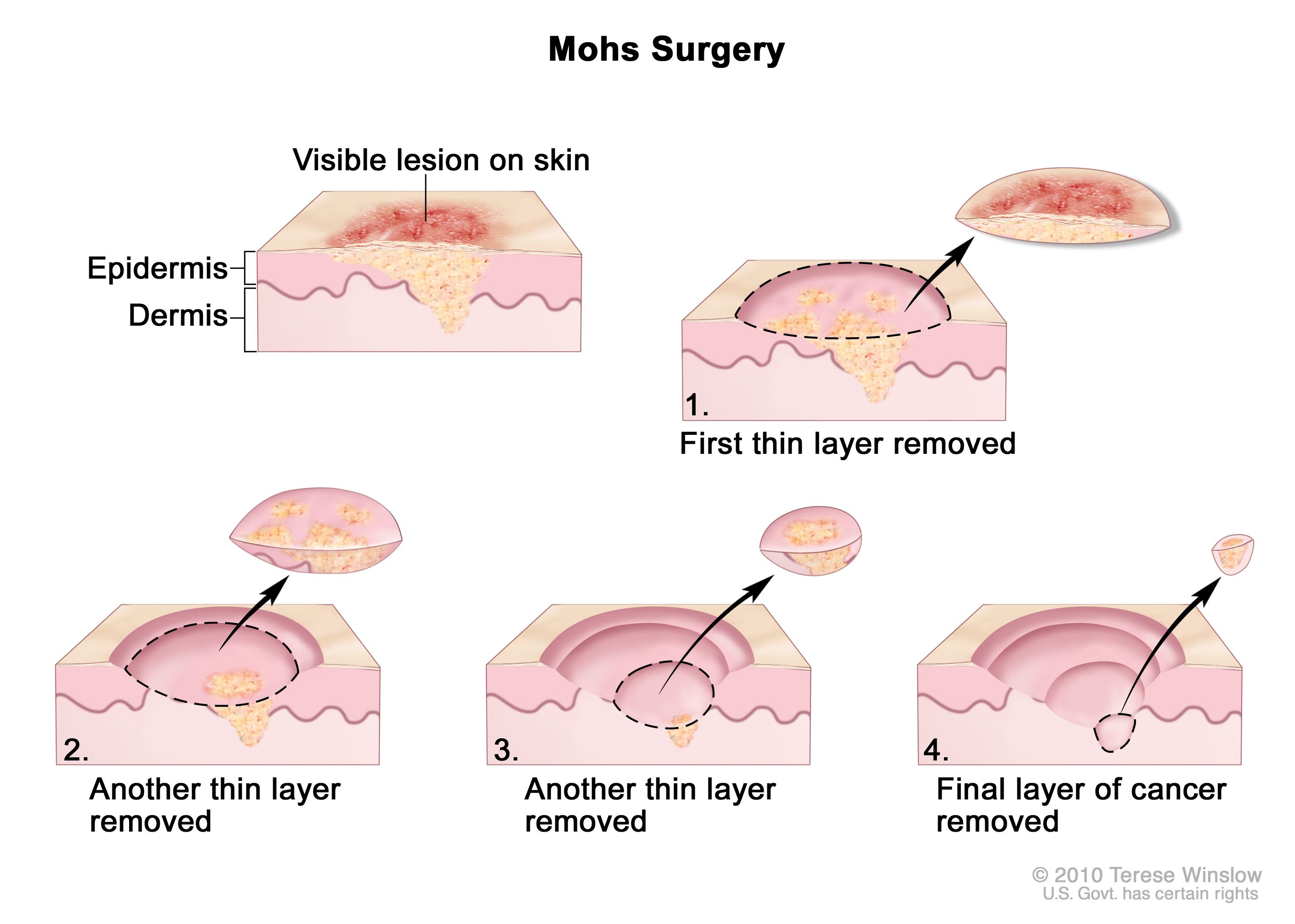 Sarcoma cancer of the skin. Traducere 