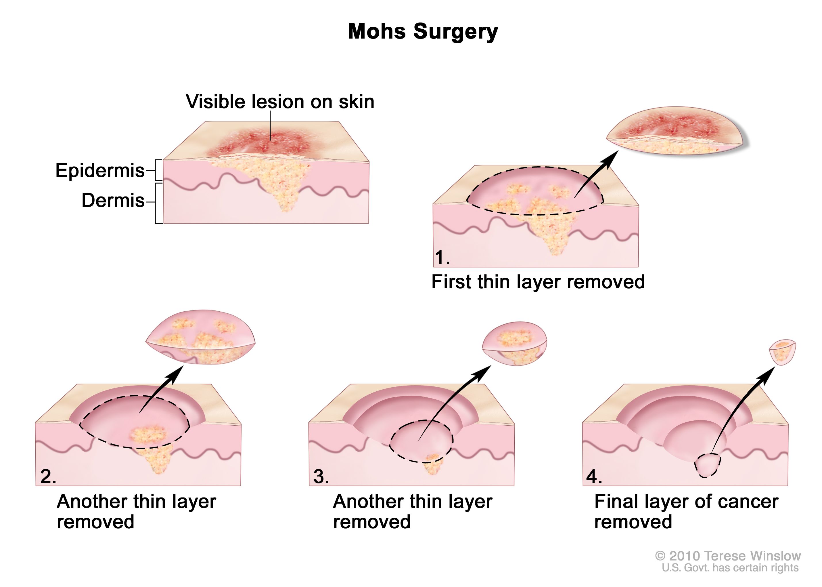 Phimosis Explained: The Road to Recovery and Treatment Options