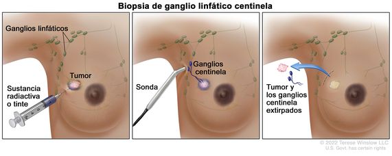 Biopsia de ganglio linfático centinela de la mama. En el dibujo se observa la manera como se hace una biopsia de ganglio linfático en tres pasos. El primer paso se encuentra en el panel de la izquierda donde se muestra la vista frontal de la mama, una jeringa y una aguja mediante la cual se inyecta una sustancia radiactiva o tinte cerca de un tumor dentro de la mama. El segundo paso se encuentra en el panel del medio donde se observa la vista frontal de la mama y una sonda que detecta la radiactividad del tinte que resalta en otro color dos ganglios centinela (primeros ganglios linfáticos a los que es probable que las células cancerosas se diseminen desde un tumor primario). El tercer paso se encuentra en el panel de la derecha donde se muestra que el tumor y los ganglios centinela se extirparon para examinarlos y determinar si tienen células cancerosas.