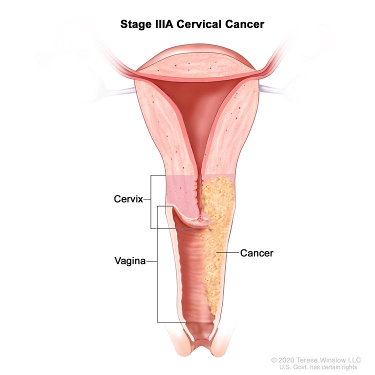 Cervical Cancer Treatment Pdq®patient Version Nci