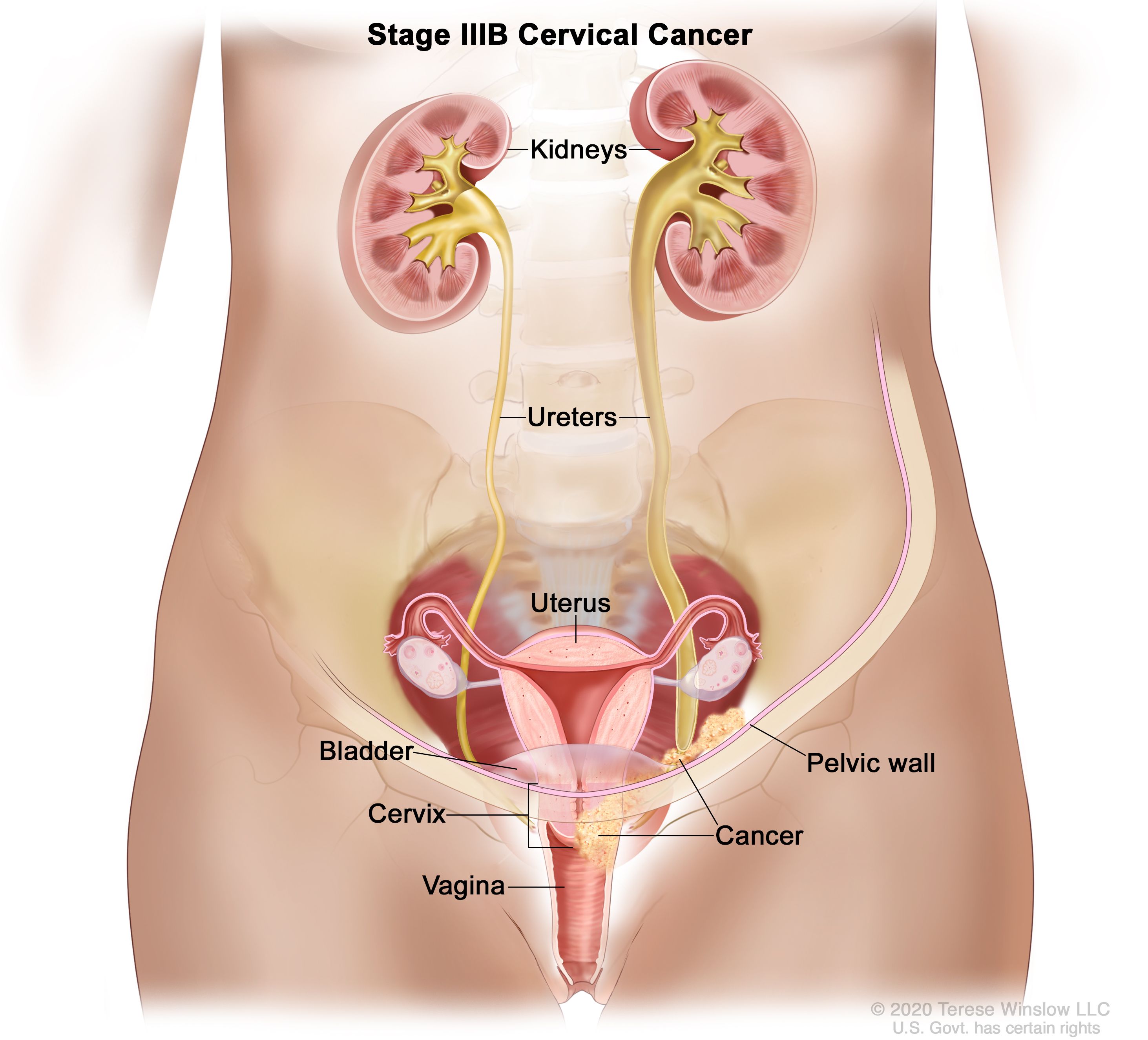 Definition of stage III cervical cancer - NCI Dictionary of Cancer Terms -  NCI