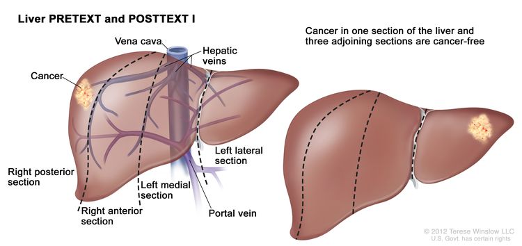 Liver PRETEXT and POSTTEXT I; drawing shows two livers. Dotted lines divide each liver into four vertical sections of about the same size. In the first liver, cancer is shown in the section on the far left. In the second liver, cancer is shown in the section on the far right.
