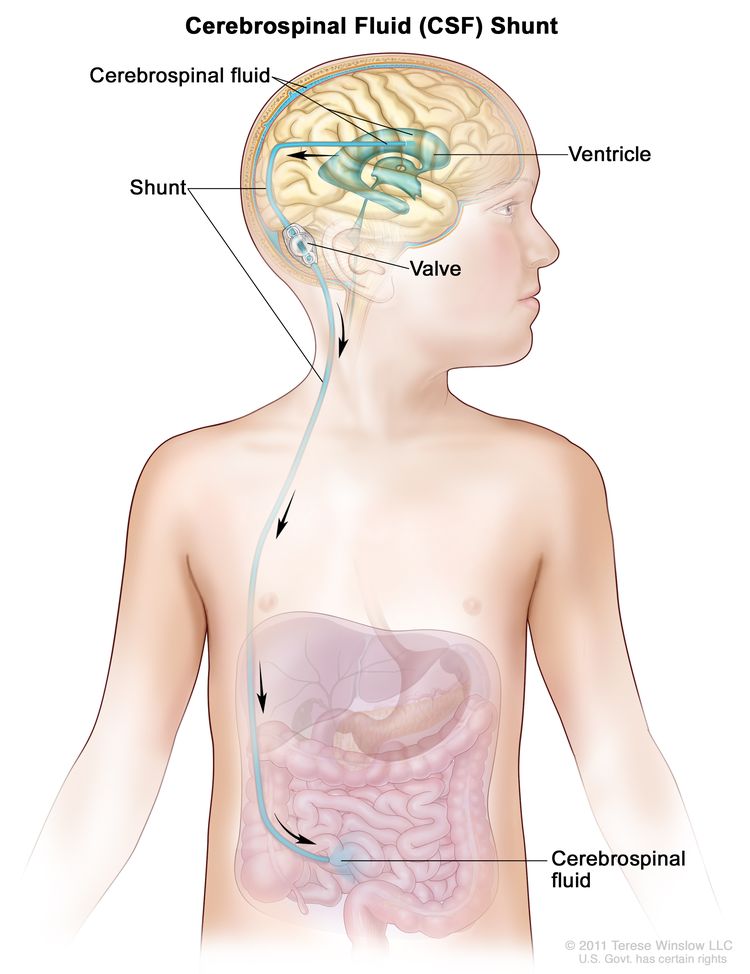 Cerebrospinal fluid (CSF) diversion; drawing shows extra CSF flowing through a tube (shunt) from a ventricle in the brain into the abdomen. The shunt goes from the ventricle, under the skin in the neck and chest, and into the abdomen. Also shown is a valve that controls the flow of CSF.