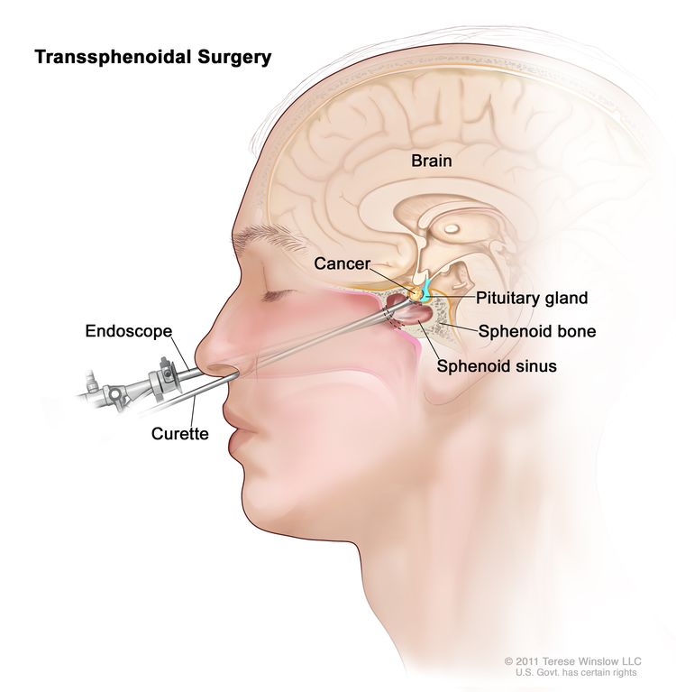 Transsphenoidal surgery; drawing shows an endoscope and a curette inserted through the nose and sphenoid sinus to remove cancer from the pituitary gland. The sphenoid bone is also shown.