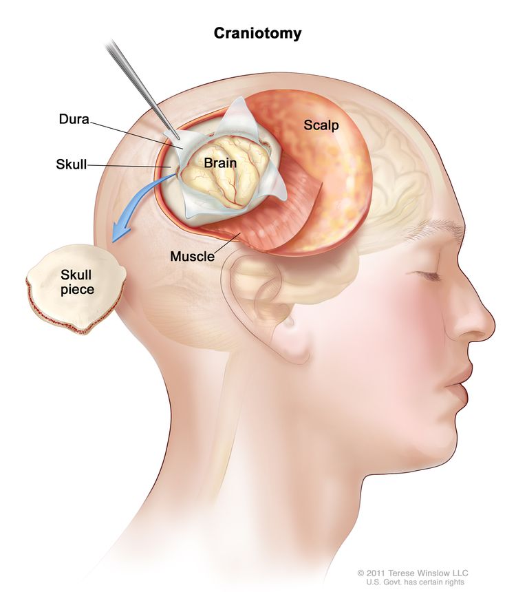 Drawing of a craniotomy showing a section of the scalp that has been pulled back to remove a piece of the skull; the dura covering the brain has been opened to expose the brain. The layer of muscle under the scalp is also shown.