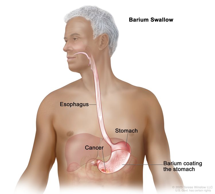 gastric cancer ucsf