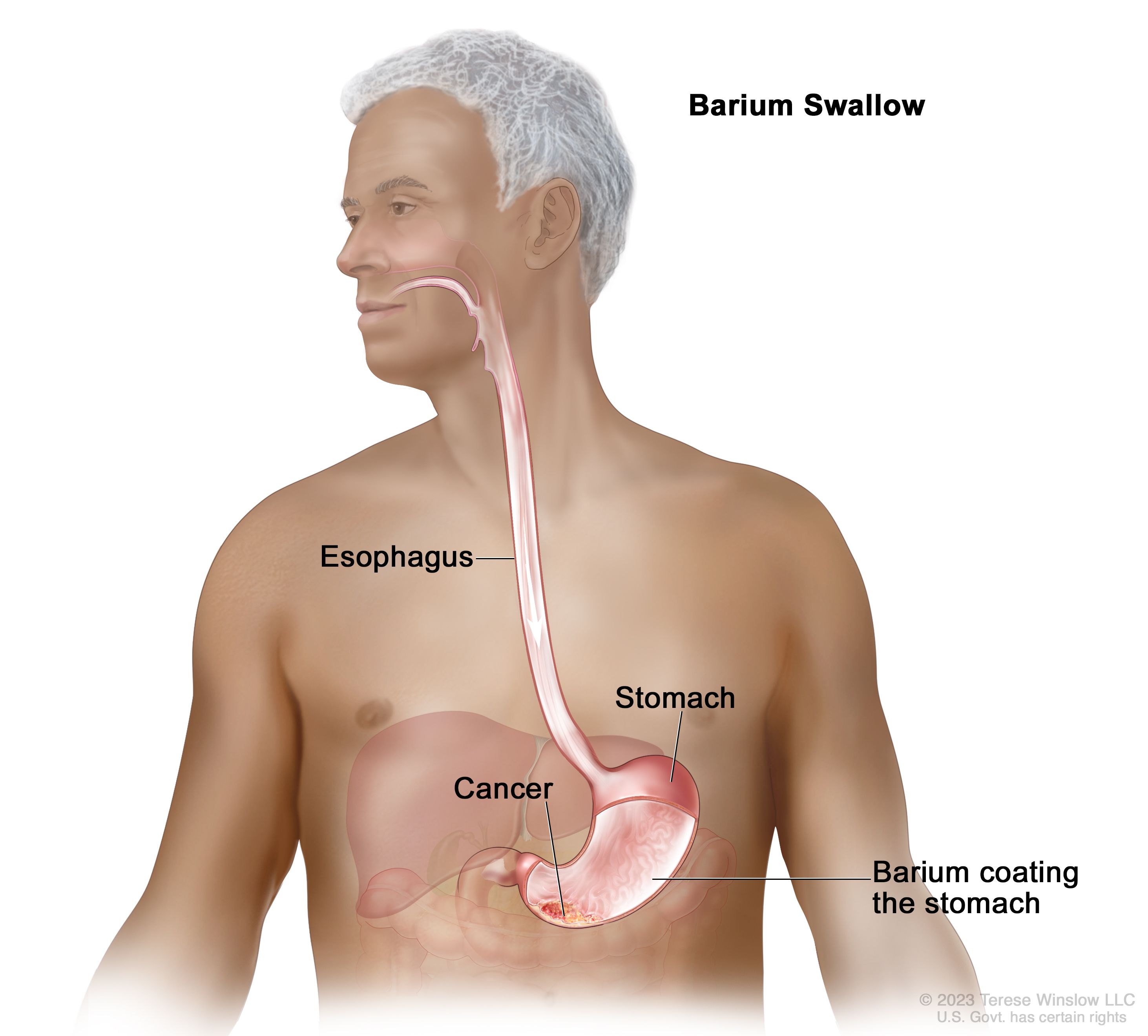 Cancer of abdominal lining