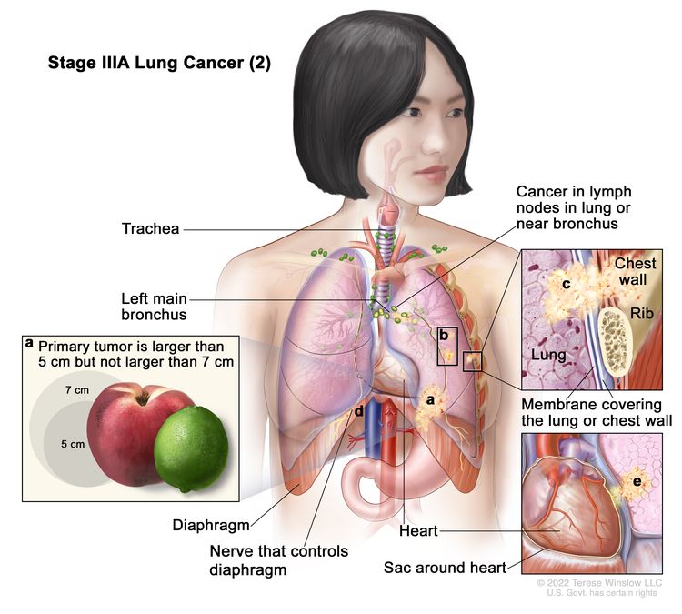 Stage IIIA lung cancer (2); drawing shows (a) a primary tumor (larger than 5 cm but not larger than 7 cm) in the left lung and cancer in lymph nodes in the lung or near the bronchus on the same side of the chest as the primary tumor. Also shown is (b) separate tumors in the same lobe of the lung as the primary tumor and cancer that has spread to (c) the chest wall and the membranes covering the lung and chest wall (top right inset); (d) the nerve that controls the diaphragm; and (e) the sac around the heart (bottom right inset). The trachea, left main bronchus, diaphragm, heart, and a rib (top right inset) are also shown.