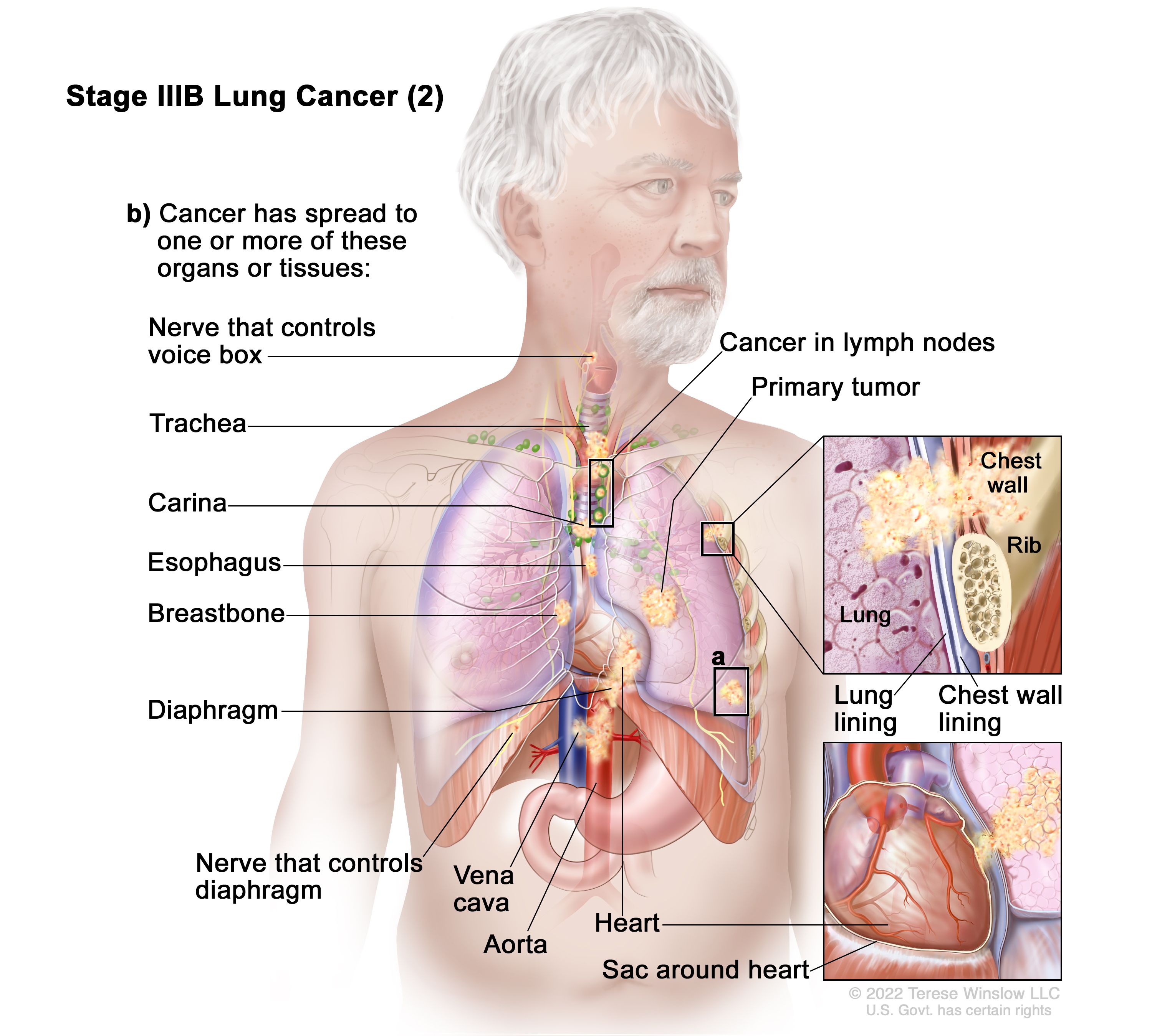 Lung Neoplasms 