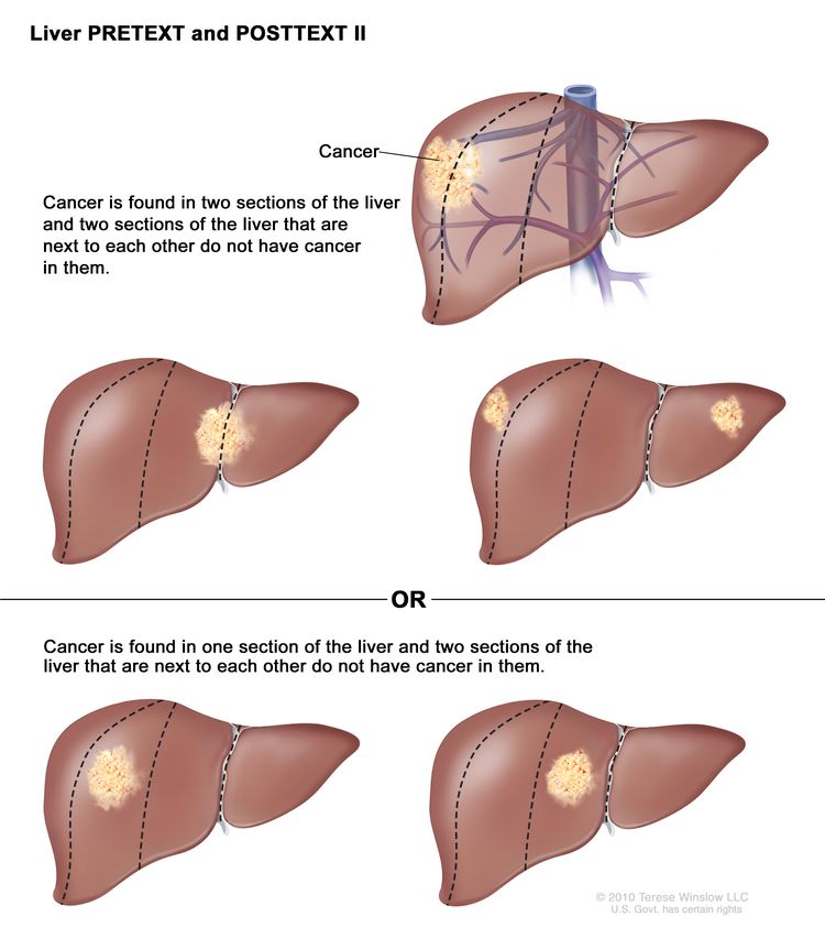 Liver PRETEXT and POSTTEXT II; drawing shows five livers. Dotted lines divide each liver into four vertical sections that are about the same size. In the first liver, cancer is shown in the two sections on the left. In the second liver, cancer is shown in the two sections on the right. In the third liver, cancer is shown in the far left and far right sections. In the fourth liver, cancer is shown in the second section from the left. In the fifth liver, cancer is shown in the second section from the right.