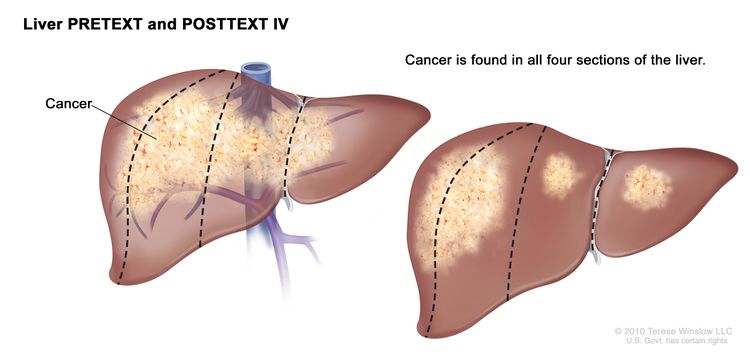 الكبد PRETEXT و POSTTEXT IV.  يظهر الرسم كبدين.  تقسم الخطوط المنقطة كل كبد إلى أربعة أقسام رأسية بنفس الحجم تقريبًا.  في الكبد الأول ، يظهر السرطان في جميع الأقسام الأربعة.  في الكبد الثاني ، يظهر السرطان في القسمين على اليسار وتظهر بقع السرطان في القسمين على اليمين.