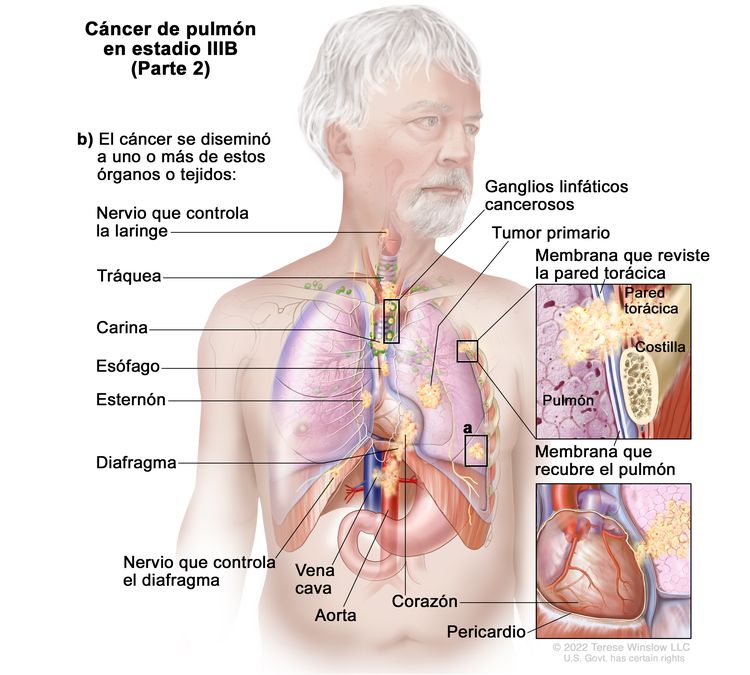 Cáncer de pulmón en estadio IIIB (Parte 2). En la imagen se observa un tumor primario en el pulmón izquierdo, un tumor separado en otro lóbulo del pulmón con el tumor primario y ganglios linfáticos cancerosos del mismo lado del tórax que el tumor primario. Los ganglios linfáticos cancerosos están alrededor de la tráquea o donde la tráquea se divide para formar los bronquios. También se observa que el cáncer se diseminó a los siguientes sitios: la pared torácica y la membrana que reviste el interior de la pared torácica, el nervio que controla la laringe, la tráquea, la carina, el esófago, el esternón, el diafragma, el nervio que controla el diafragma, la aorta, la vena cava, el corazón y el pericardio (membrana que rodea el corazón).