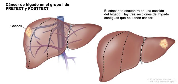 Cáncer de hígado en estadio I de PRETEXT; el dibujo muestra dos hígados. Las líneas de puntos dividen cada hígado en cuatro secciones verticales de aproximadamente el mismo tamaño. En el primer hígado, se observa cáncer en la sección extrema izquierda. En el segundo hígado, se observa cáncer en la sección extrema derecha.