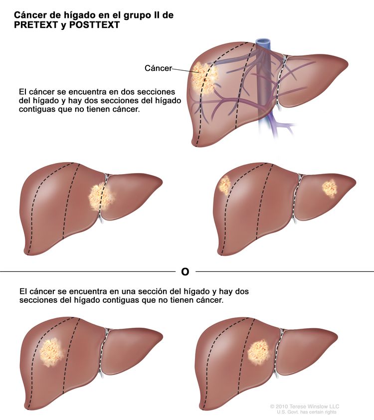 Cáncer de hígado en estadio II de PRETEXT; el dibujo muestra cinco hígados. Las líneas de puntos dividen cada hígado en cuatro secciones verticales de aproximadamente el mismo tamaño. En el primer hígado, se observa cáncer en las dos secciones de la izquierda. En el segundo hígado, se observa cáncer en las dos secciones de la derecha. En el tercer hígado, se observa cáncer en las secciones de la extrema izquierda y la extrema derecha. En el cuarto hígado, se observa cáncer en la segunda sección desde la izquierda. En el quinto hígado, se observa cáncer en la segunda sección desde la derecha.
