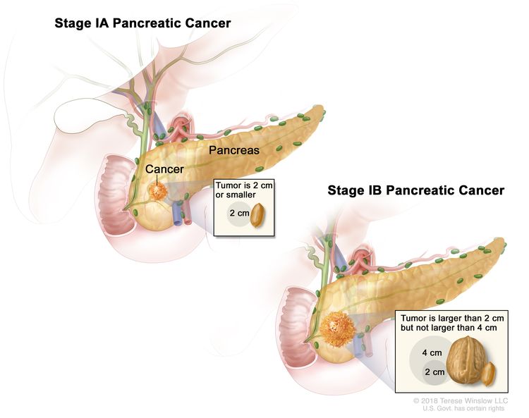 Stage I pancreatic cancer; drawing on the left shows stage IA pancreatic cancer. The cancer is in the pancreas and the tumor is 2 centimeters or smaller. An inset shows 2 centimeters is about the size of a peanut. The drawing on the right shows stage IB pancreatic cancer. The cancer is in the pancreas and the tumor is larger than 2 centimeters but not larger than 4 centimeters. An inset shows 2 centimeters is about the size of a peanut and 4 centimeters is about the size of a walnut.