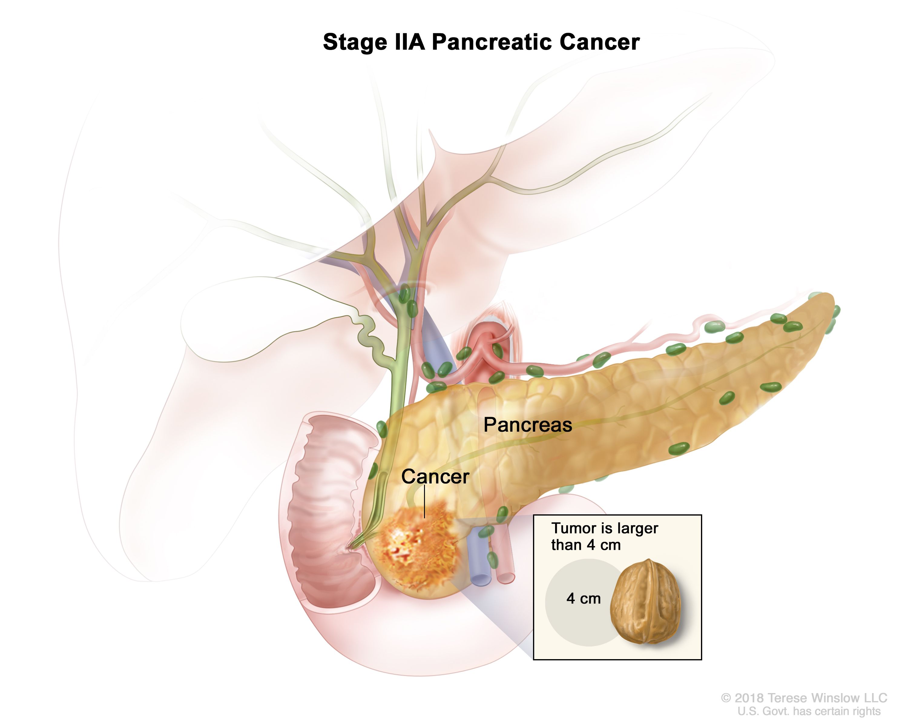 Pancreatic cancer from pancreatitis - Pancreatic cancer blood tests, CA (Antigen carbohidrat)