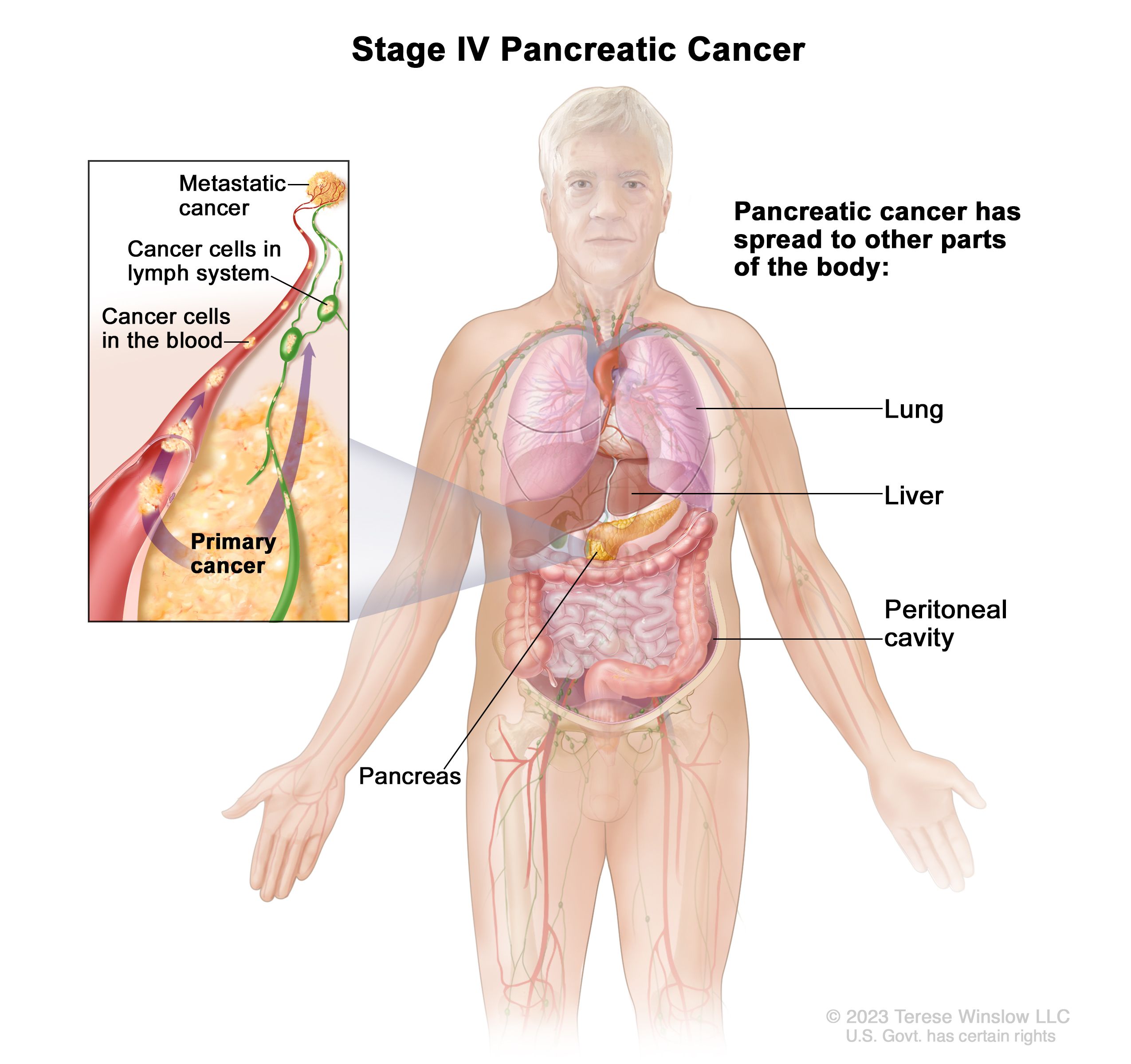 pancreatic cancer with liver lesions