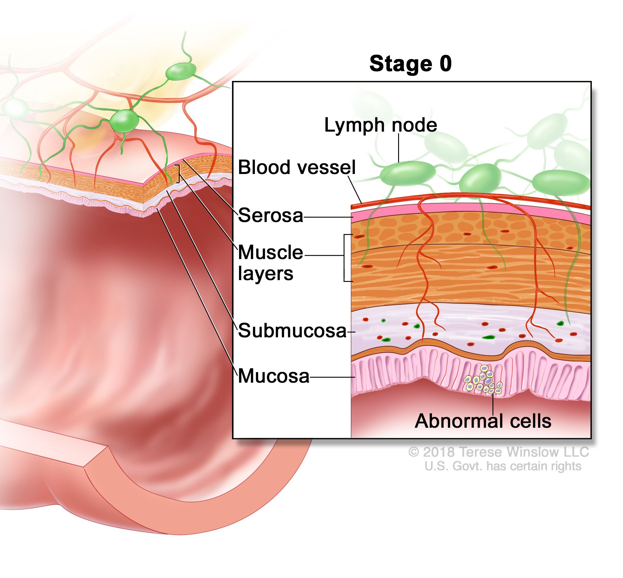 Colon Cancer Treatment Pdq Health Professional Version National Cancer Institute