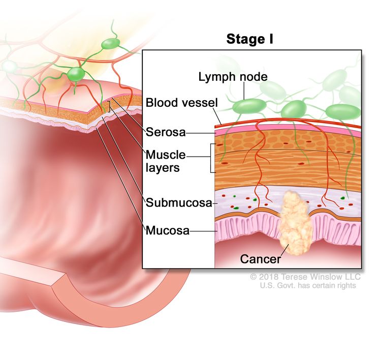 Колоректальный рак I стадии;  на чертеже показано поперечное сечение ободочной / прямой кишки.  На вставке показаны слои стенки толстой / прямой кишки с раком слизистой и подслизистой оболочки.  Также показаны мышечные слои, серозная оболочка, кровеносный сосуд и лимфатические узлы.