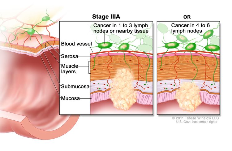 Колоректальный рак IIIA стадии;  на чертеже показано поперечное сечение ободочной / прямой кишки и вставка из двух панелей.  На каждой панели показаны слои стенки толстой / прямой кишки: слизистая, подслизистая, мышечные слои и сероза.  Также показаны кровеносный сосуд и лимфатические узлы.  На первой панели показан рак слизистой, подслизистой и мышечной слоев, а также 2 лимфатических узлов.  На второй панели показан рак слизистой и подслизистой оболочки и 5 лимфатических узлов.