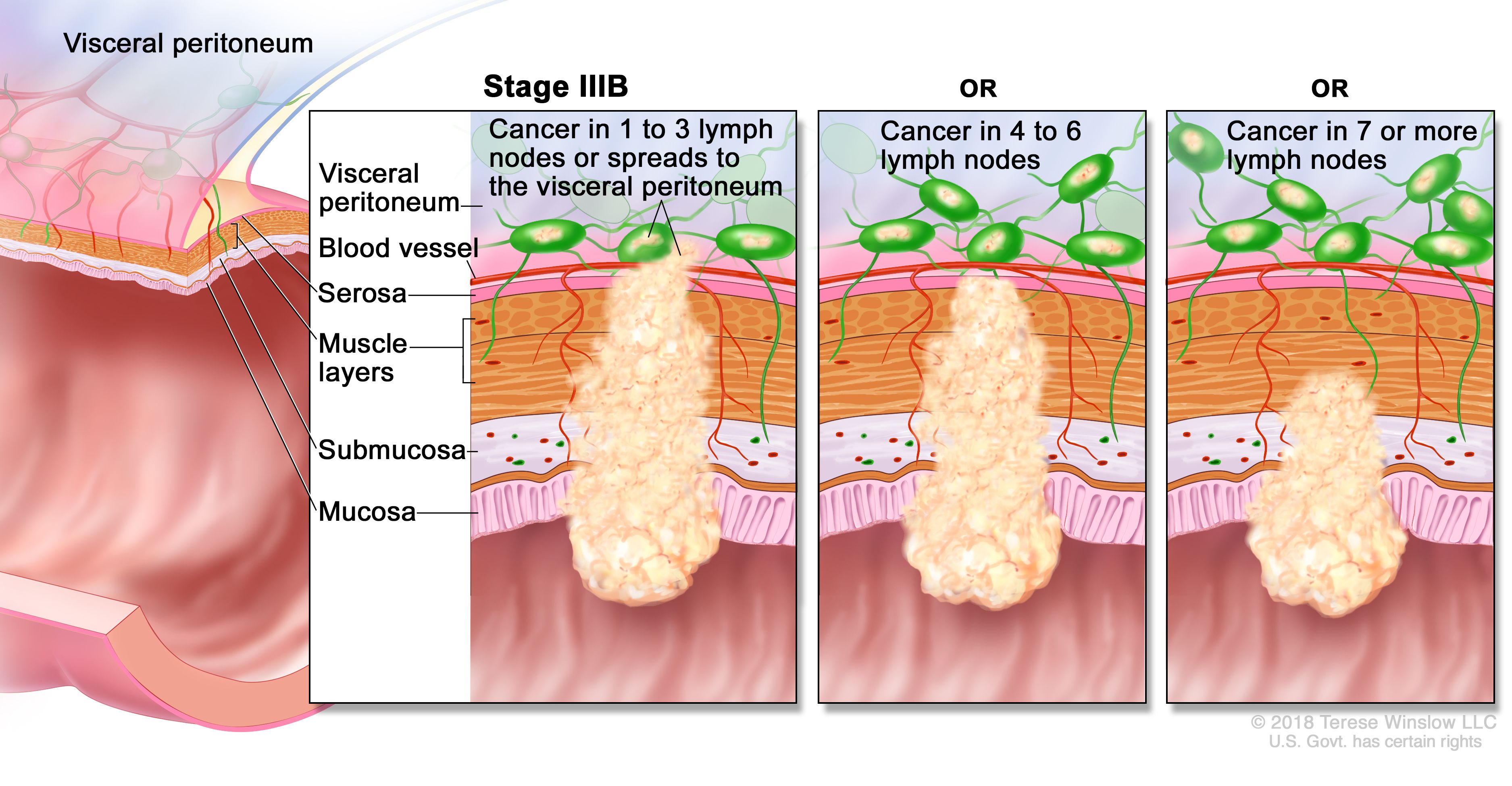 cancerul de colon stadiul 4)
