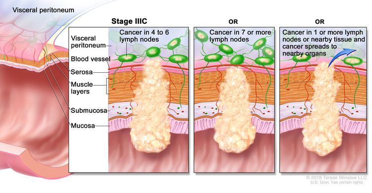 Stage IIIC colorectal cancer; drawing shows a cross-section of the colon/rectum and a three-panel inset. Each panel shows the layers of the colon/rectum wall: the mucosa, submucosa, muscle layers, and serosa. Also shown are a blood vessel and lymph nodes. The first panel shows cancer in all layers, in 4 lymph nodes, and in the visceral peritoneum. The second panel shows cancer in all layers and in 7 lymph nodes. The third panel shows cancer in all layers, in 2 lymph nodes, and spreading to nearby organs.