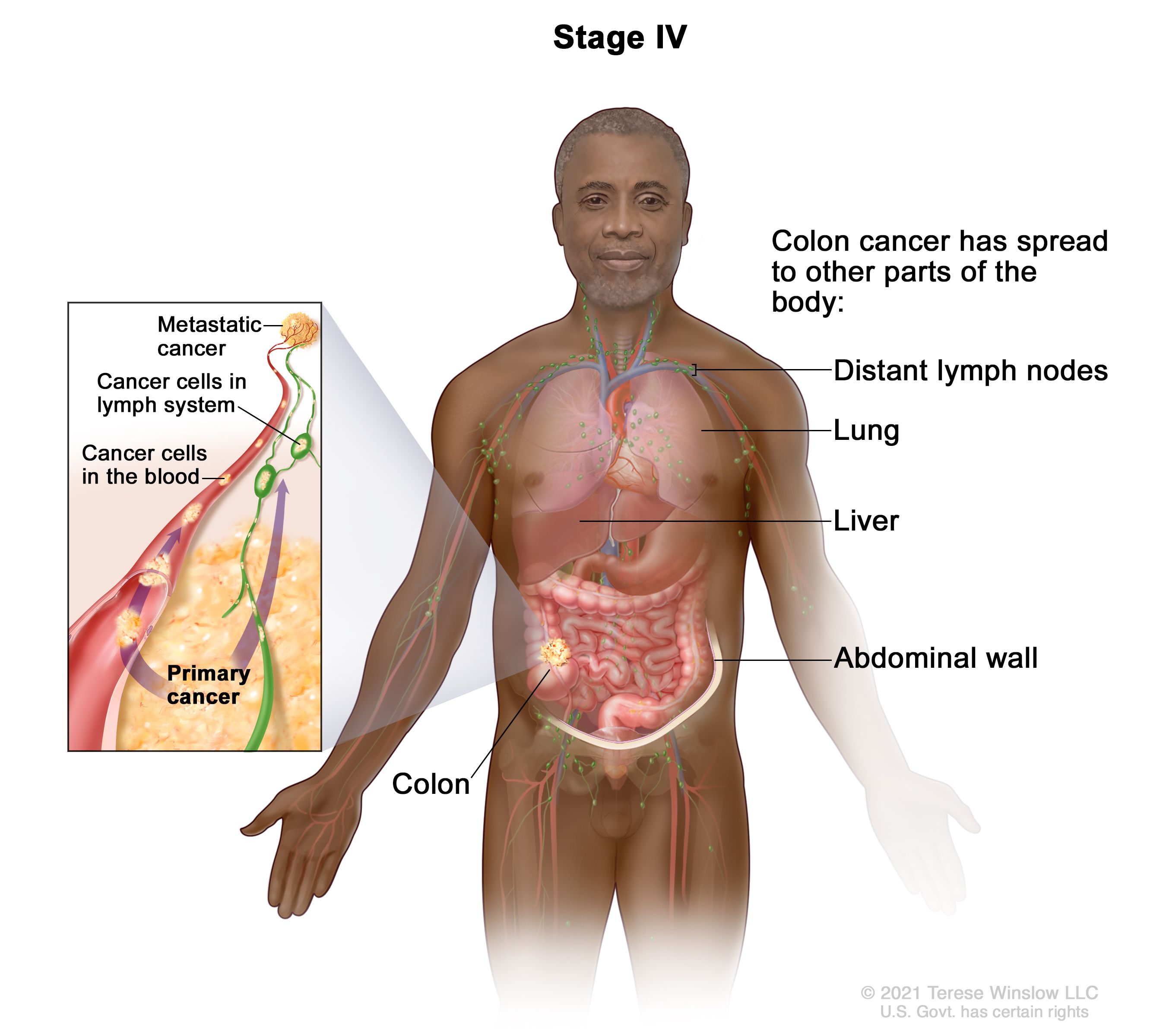 Definition of stage IV colorectal cancer - NCI Dictionary of