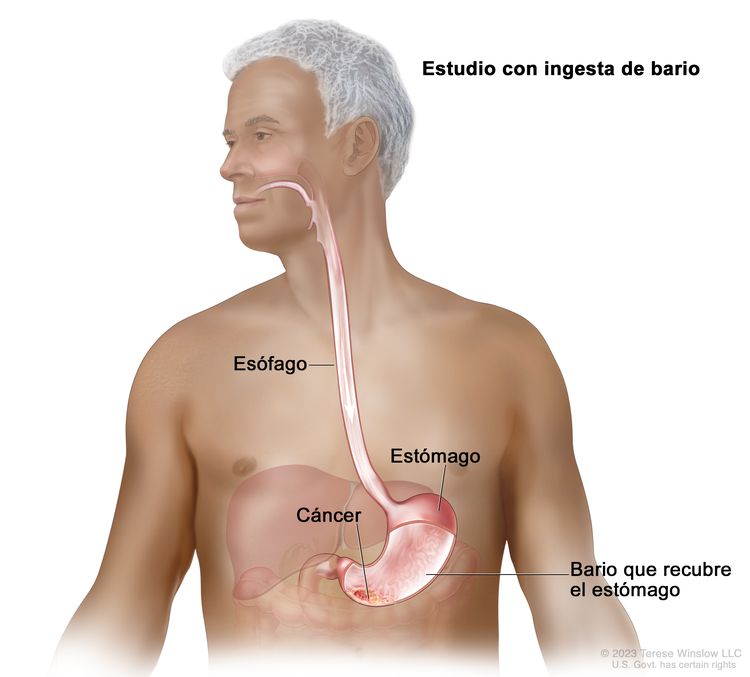 Ingesta de bario para el cáncer de estómago; el dibujo muestra el bario líquido que fluye a través del esófago y hacia el estómago.
