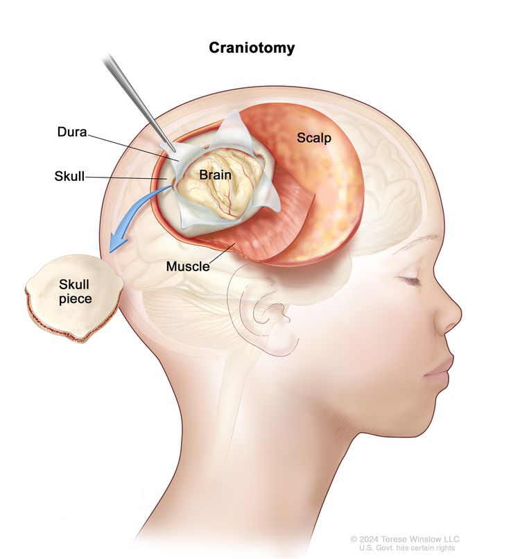 Drawing of a craniotomy showing a section of the scalp that has been pulled back to remove a piece of the skull; the dura covering the brain has been opened to expose the brain. The layer of muscle under the scalp is also shown.
